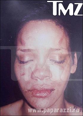 В прессу попали фото разбитого лица Рианны