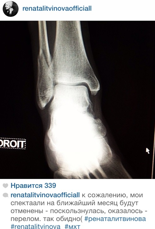Сразу после взрыва в голове Рената Литвинова сломала ногу