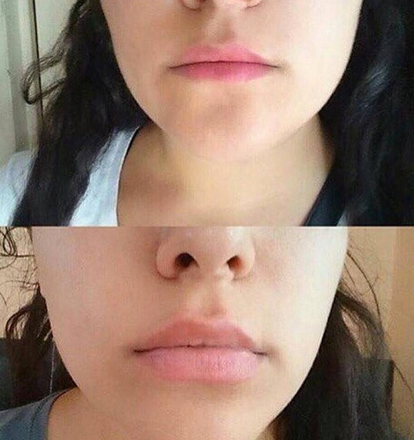 Фото накаченных губ до и после на тонкие губы