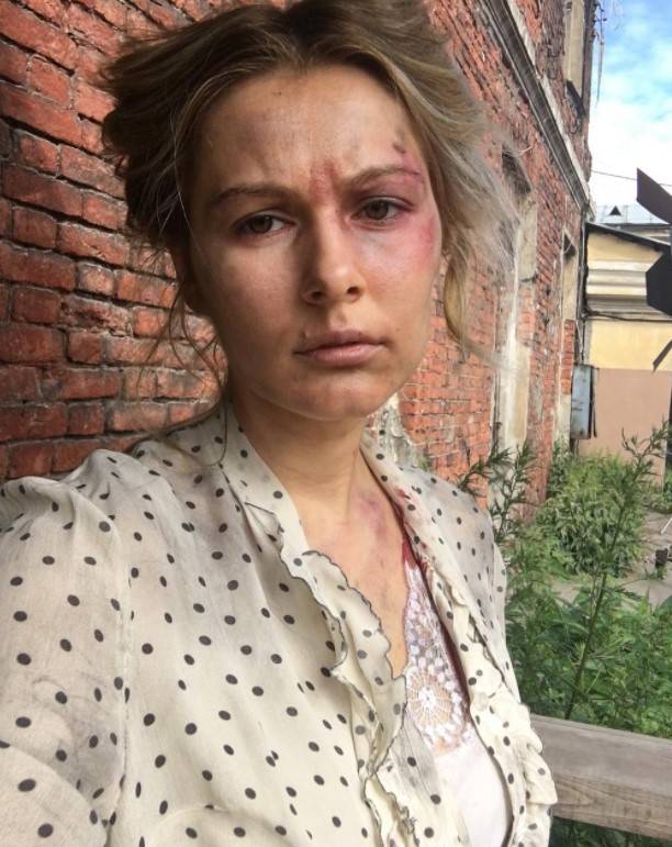 После публикации фото мужа, беременная Мария Кожевникова ужаснула синяками на лице