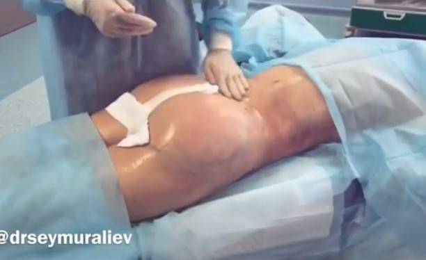Певица Асти разместила шокирующее видео с операции по увеличению ягодиц