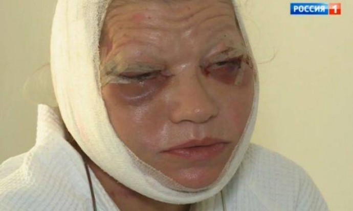 Не родившую жену Гогена Солцева парализовало после пластических операций