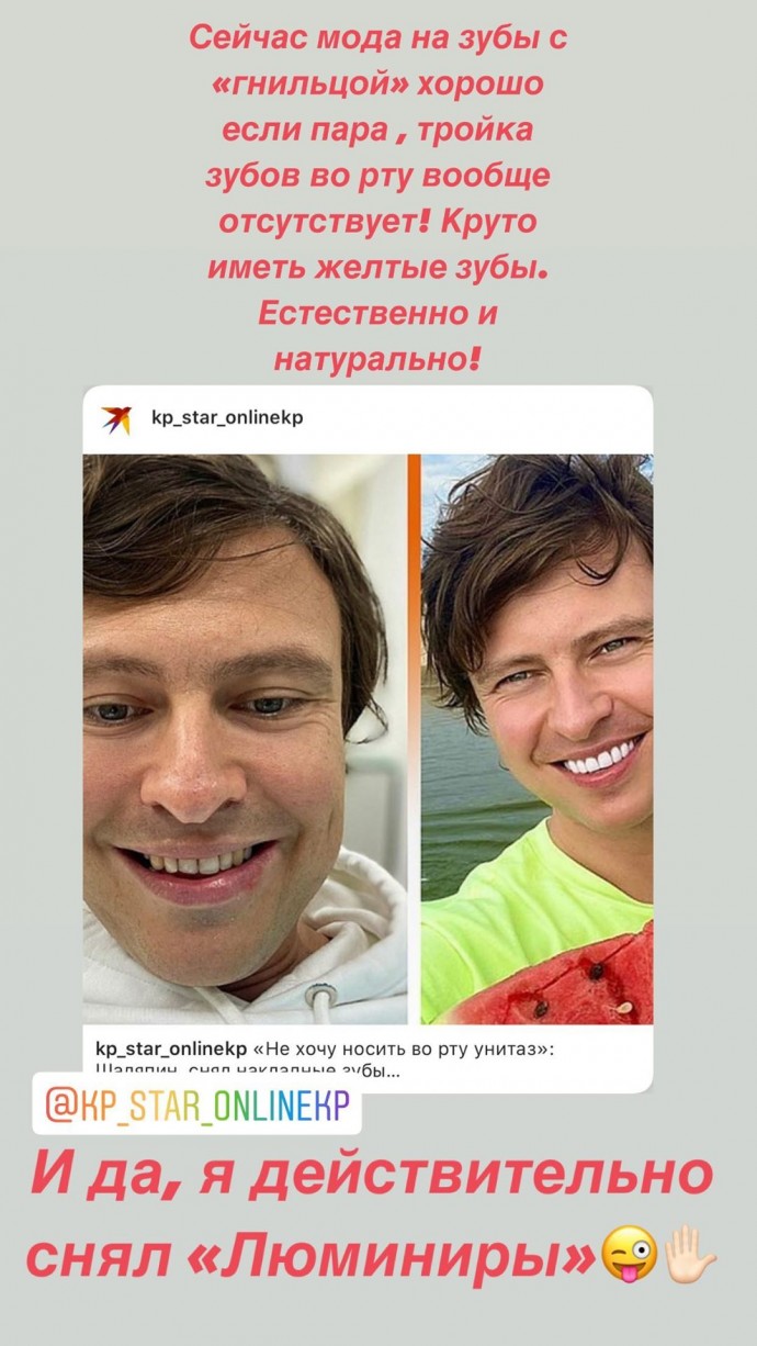 Прохор Шаляпин показал фото с жёлтыми зубами после снятия люминиров