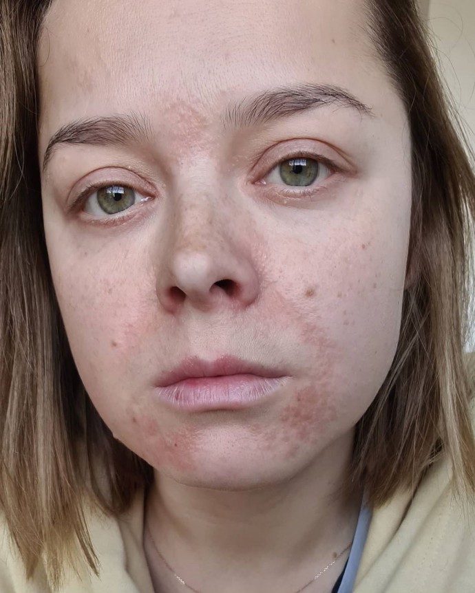 "Оно сохнет и жжёт": Наталья Медведева показала лицо, обезображенное хронической болезнью