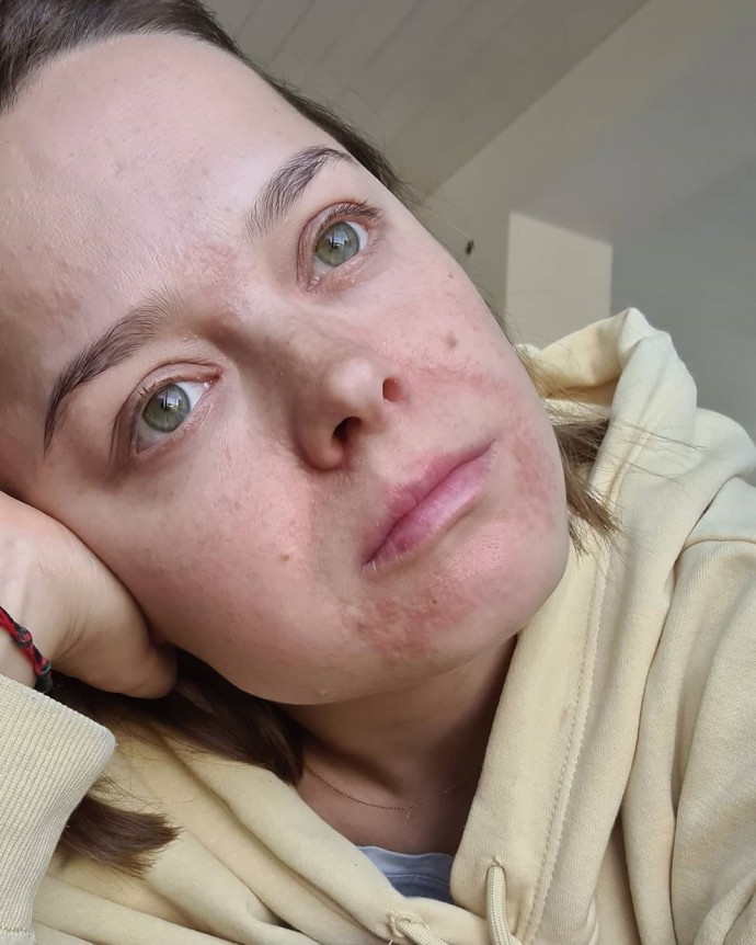 "Оно сохнет и жжёт": Наталья Медведева показала лицо, обезображенное хронической болезнью