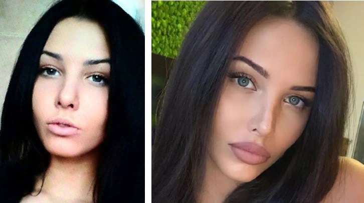 «Я увеличила ее»: Анастасия Решетова наконец призналась в пластике и показала фото до и после