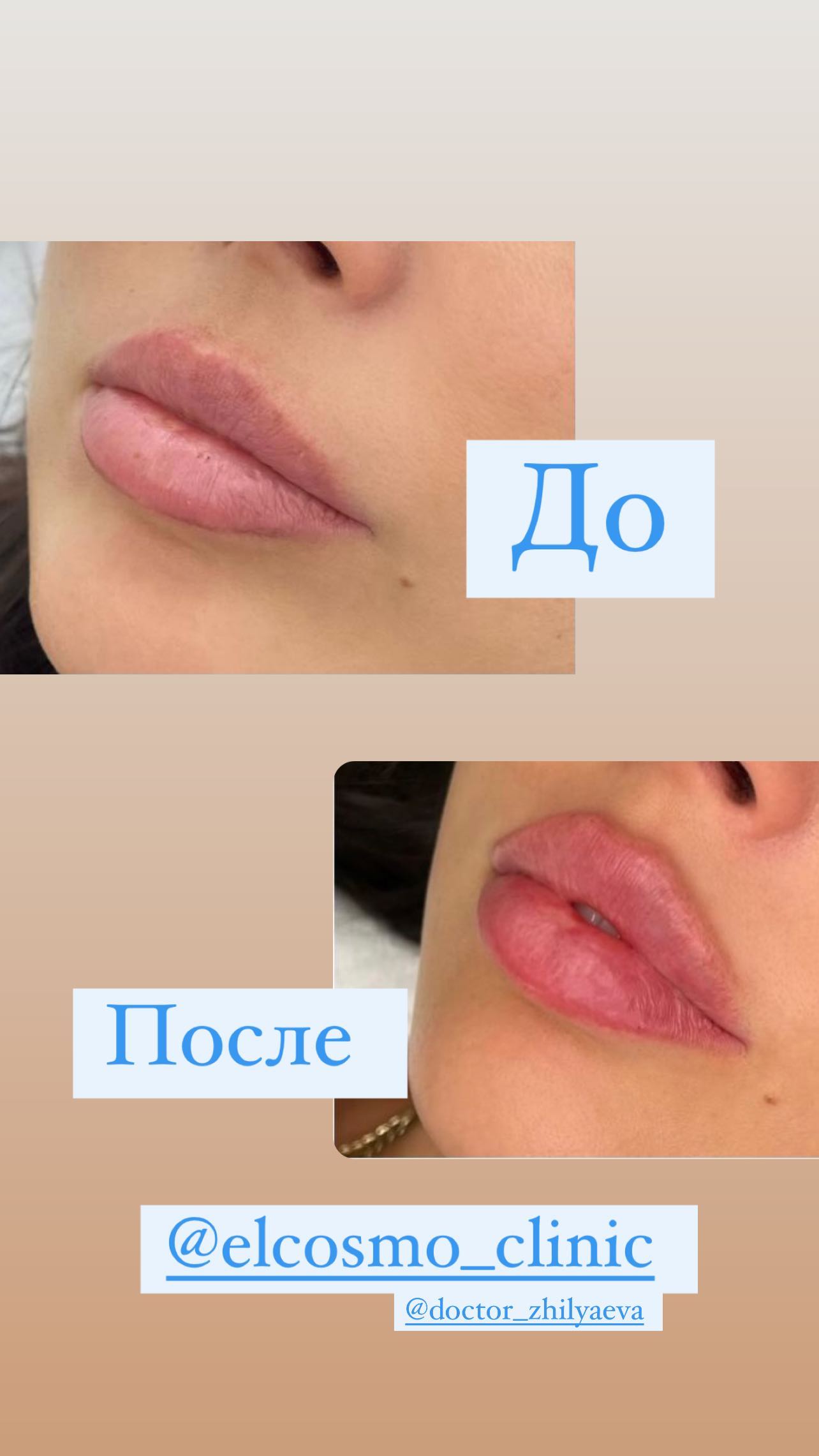 "Что-то изменилось?": Оксана Самойлова показала результат переделанных губ



