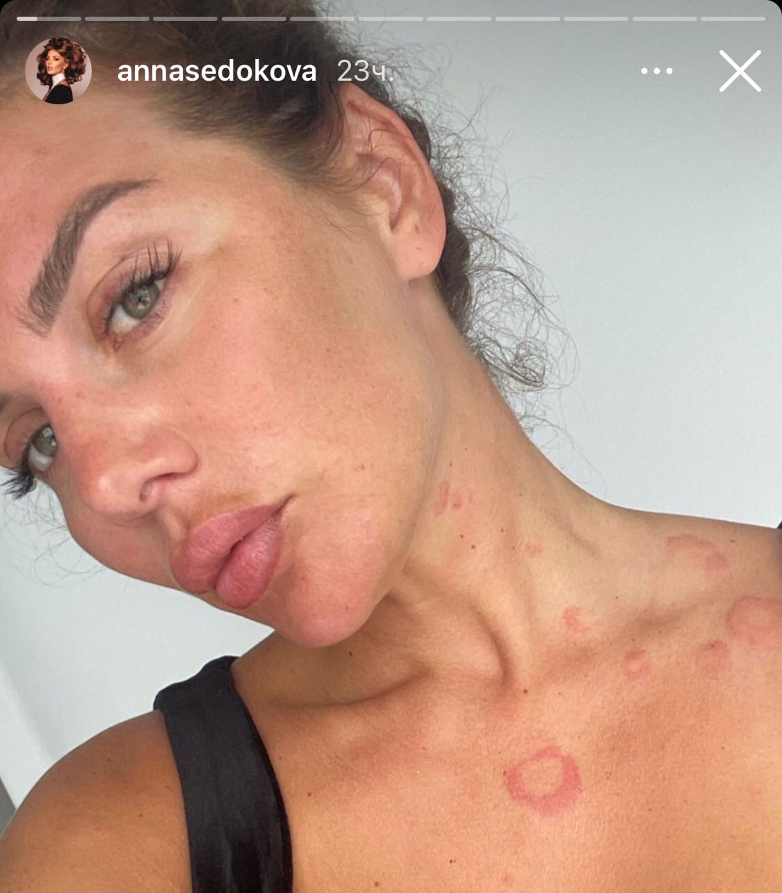 Анна Седокова чуть не задохнулась из-за отека Квинке
