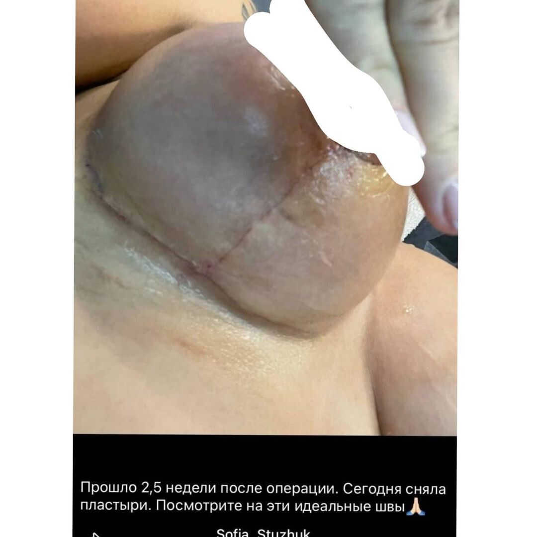 «Наконец-то дошло»: недавно сделав силиконовую грудь, Софья Стужук снова готовится к операции