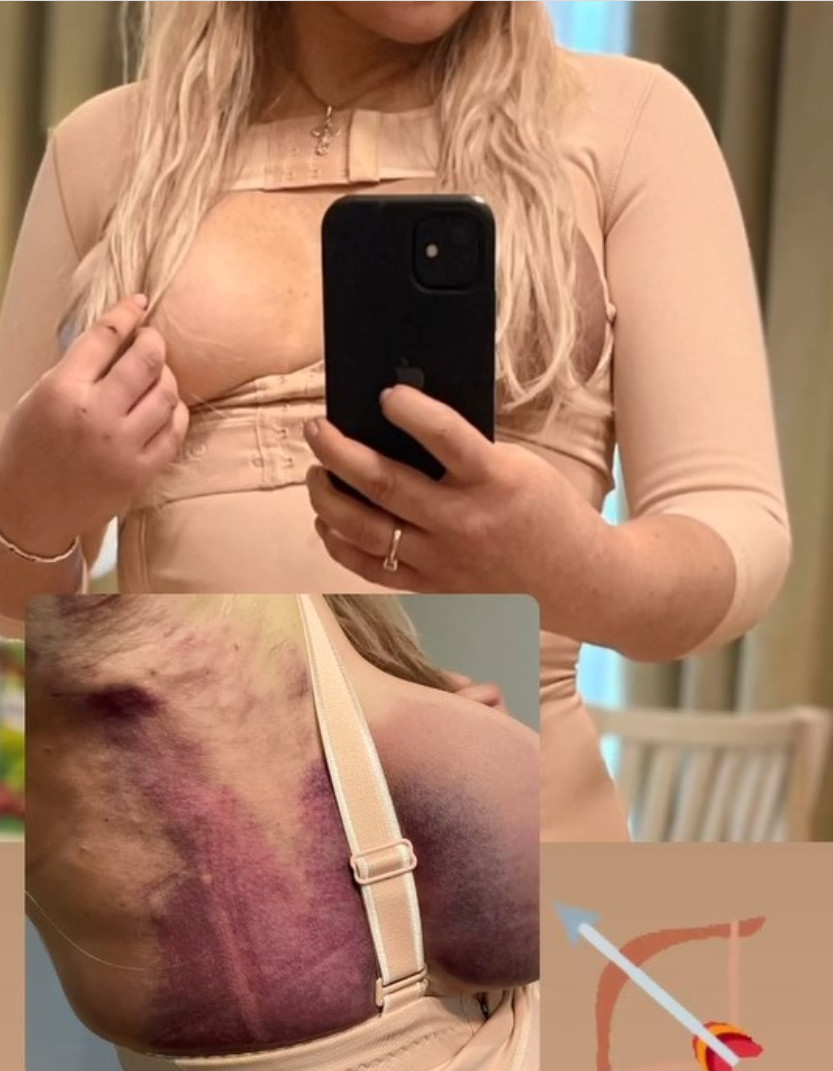Дана Борисова сделала селфи, показав грудь и гематомы после операции