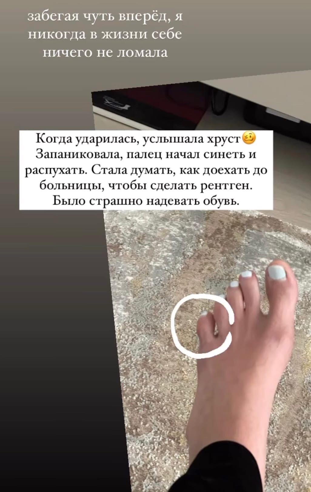 Алена Шишкова сломала палец