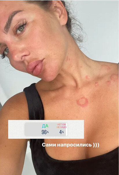 «Сами напросились»: Анна Седокова показала изуродованное болезнью тело