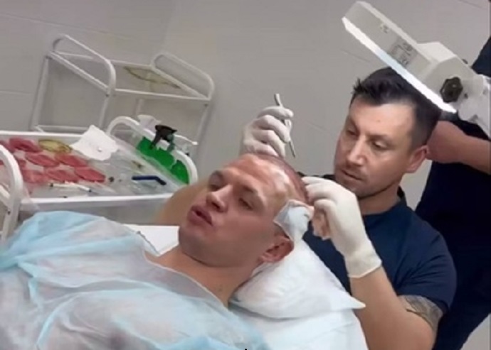 "Я не лысый, просто волосы отваливаются": Дмитрий Тарасов сделал пересадку волос. ТОП-10 российских звезд мужского пола, которые искусственно нарастили себе волосы и бороды