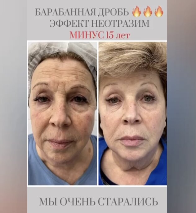 «Барабанная дробь!»: над 77-летней Ларисой Рубальской три месяца колдовали косметологи, результат удивил многих