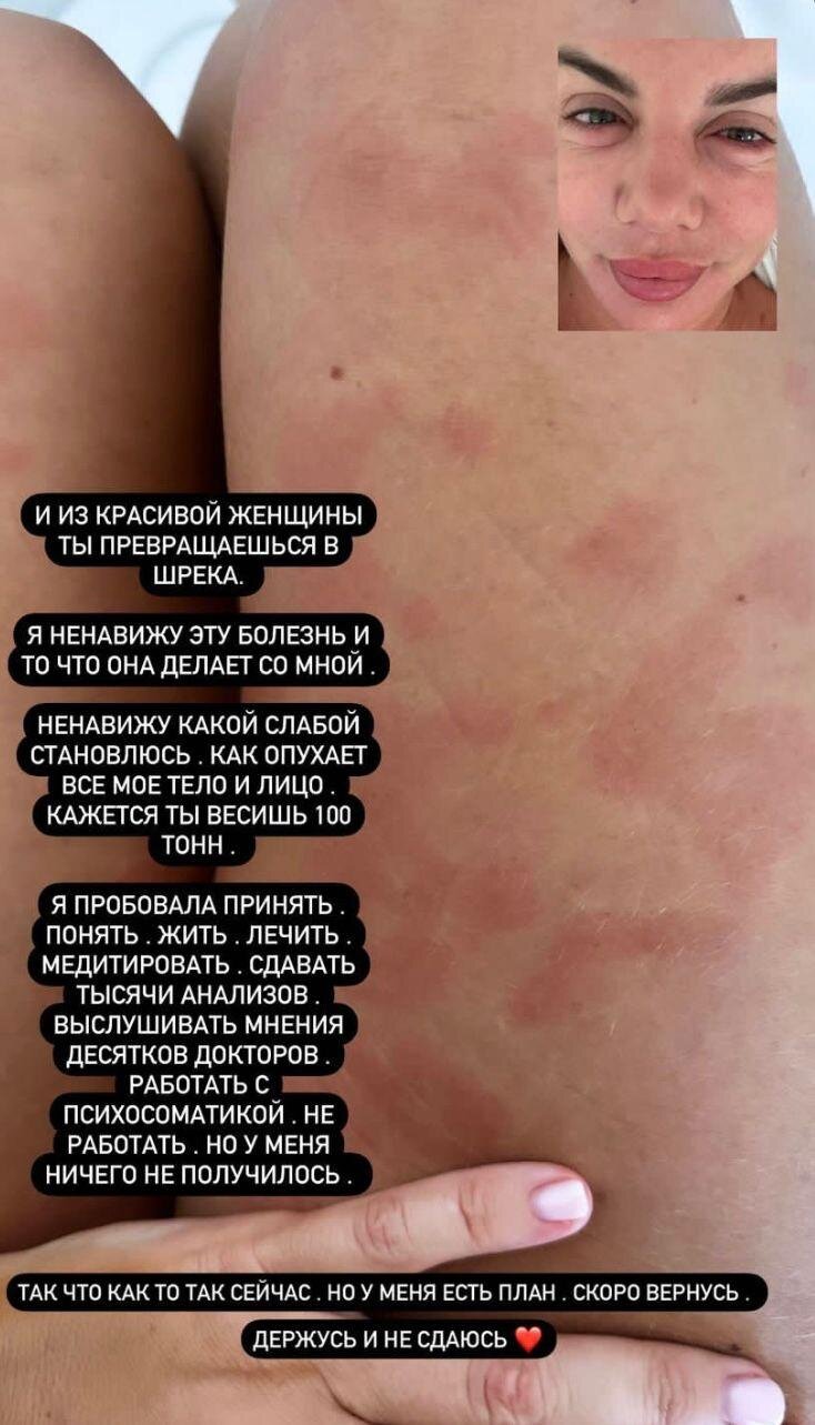 «Превращаешься в Шрека»: Анна Седокова показала изменённое болезнью лицо