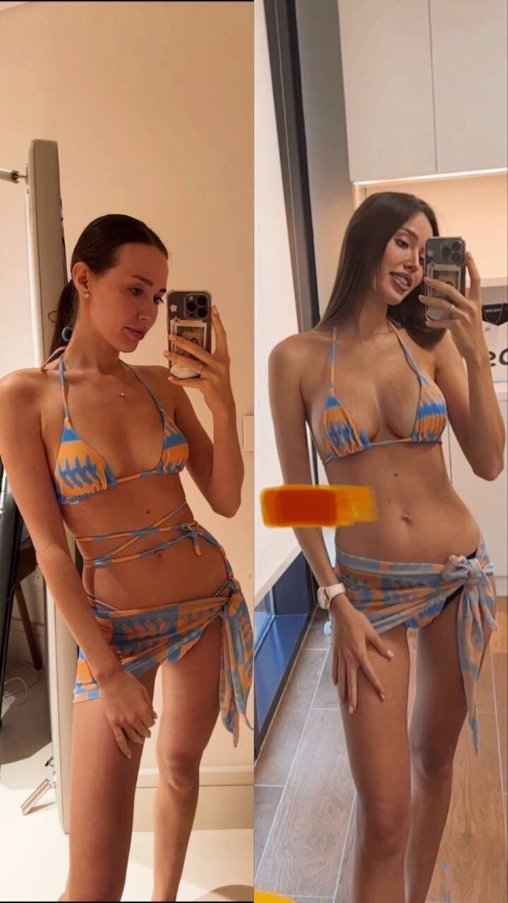 Анастасия Костенко показала, как выглядит её грудь через месяц после пластики