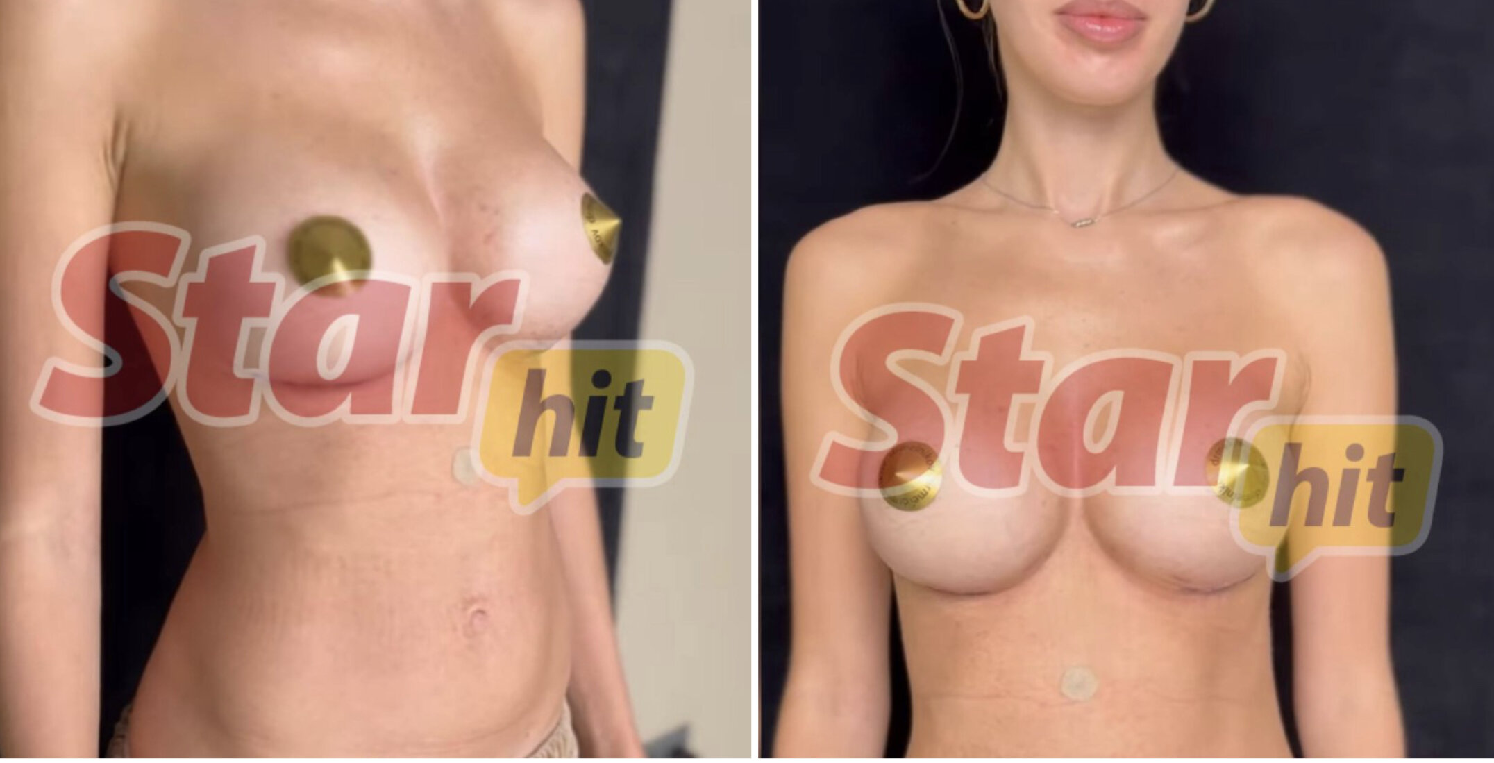 Анастасия Костенко показала, как выглядит её грудь через месяц после пластики