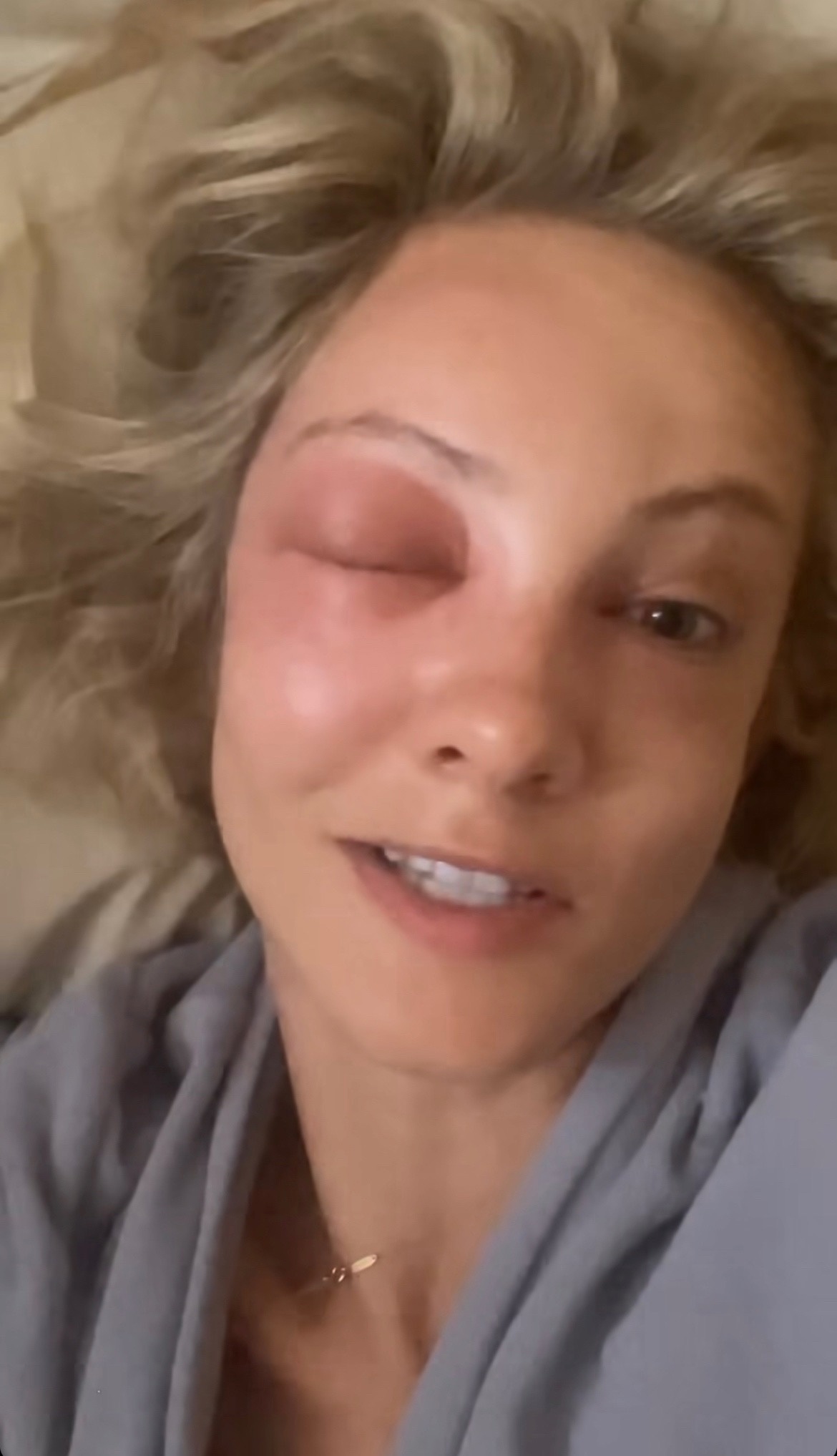 "Отек по всему лицу": Полина Максимова пострадала от укуса пчелы
