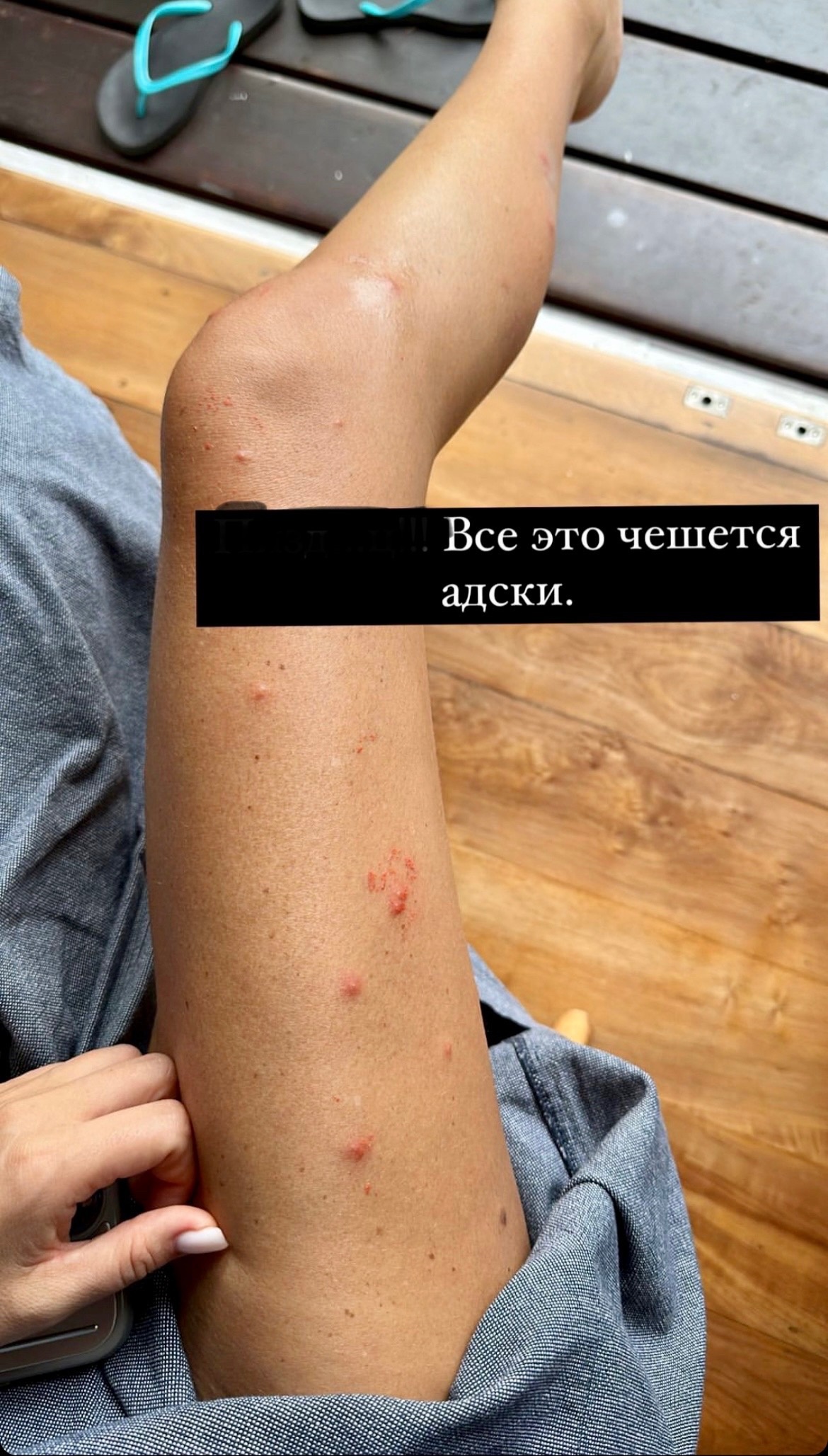 "На теле живого места нет": Ксения Бородина пострадала на пляже