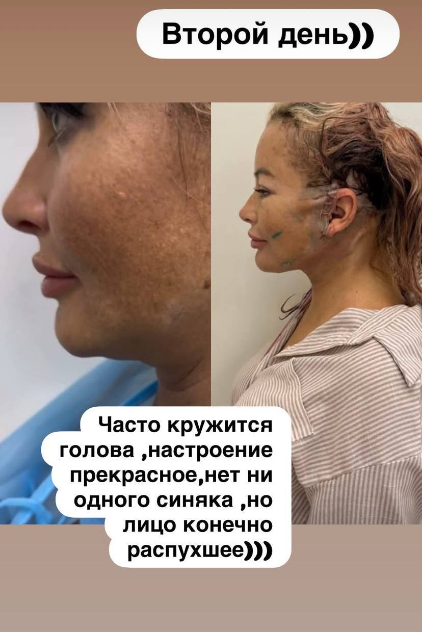 Дана Борисова показала результат очередной пластической операции